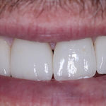 Whitening followed by Veneers - After