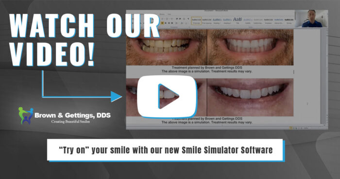 BrownGettings-Smile-Simulator-Web-Image-1200×630-v1 smile simulator video