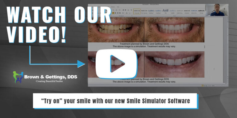 BrownGettings-Smile-Simulator-Web-Image-1200×630-v1 smile simulator video