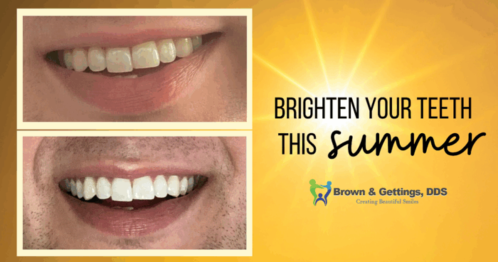 Brown_Blog_1200x630 brighten your smile
