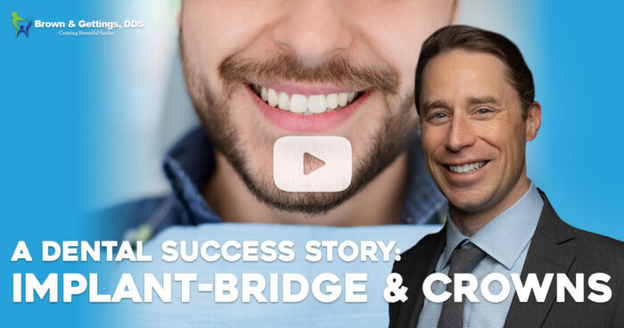 implant bridges and crowns video