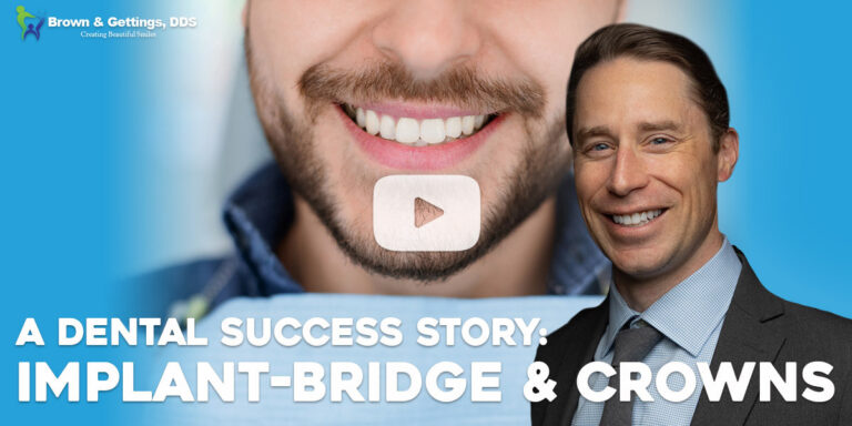 Brown-Implant_Bridge_Crowns_Success_Story-web-image-v1 implant bridges and crowns video