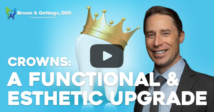Dr-Brown-Speaks-the-Tooth-Crowns-web-image-1200×630-v1 crowns, a functional and esthetic upgrade video