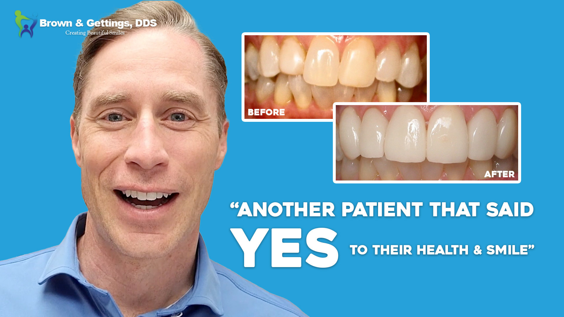 See This Remarkable Smile Transformation! – Brown & Gettings, DDS ...