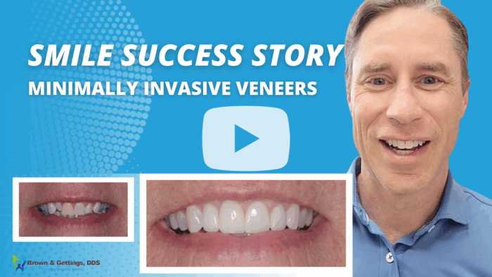 Brown_Smile Success Story_Minimally Invasive Veneers_Thumbnail