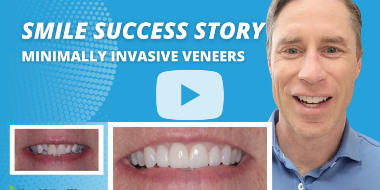 Brown_Smile Success Story_Minimally Invasive Veneers_Thumbnail
