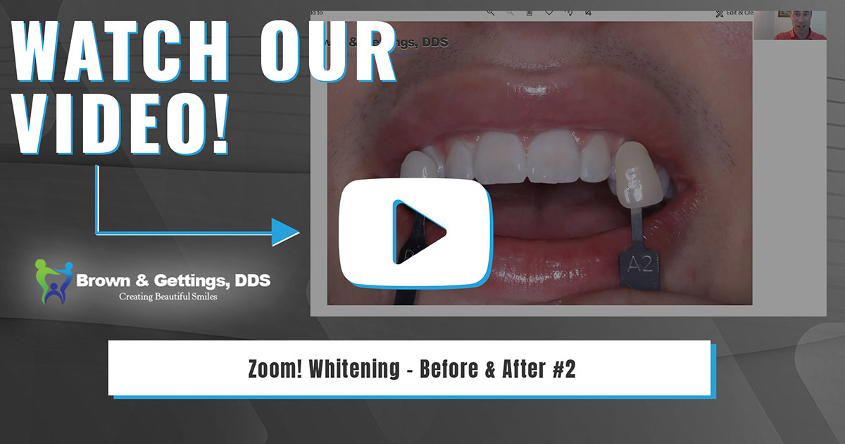 Zoom! Whitening - Before & After 2 – Brown & Gettings, DDS - West