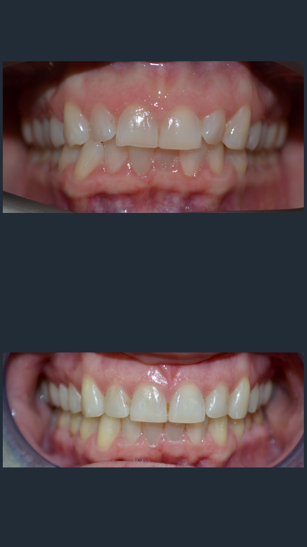 Clear Adult Braces in West Chester