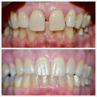 Clear Aligners Before & After