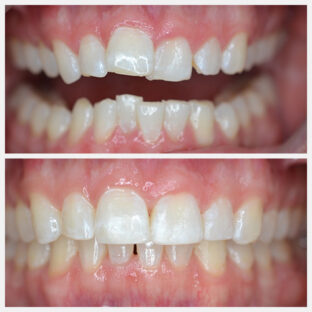 Before & After