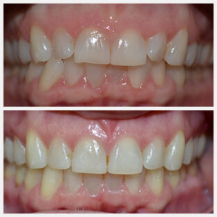 Before & After