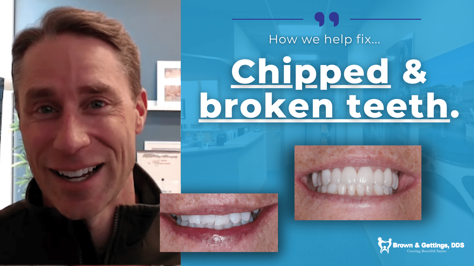 No More Broken & Chipped Teeth: Check Out This Stunning Transformation ...