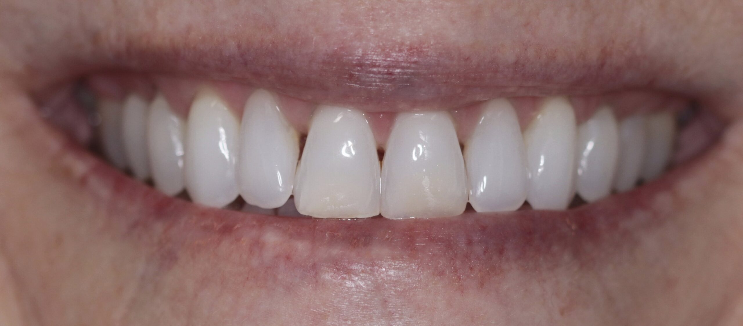 Clear Adult Braces in West Chester