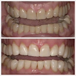 Patient 63 – KoRo Whitening
