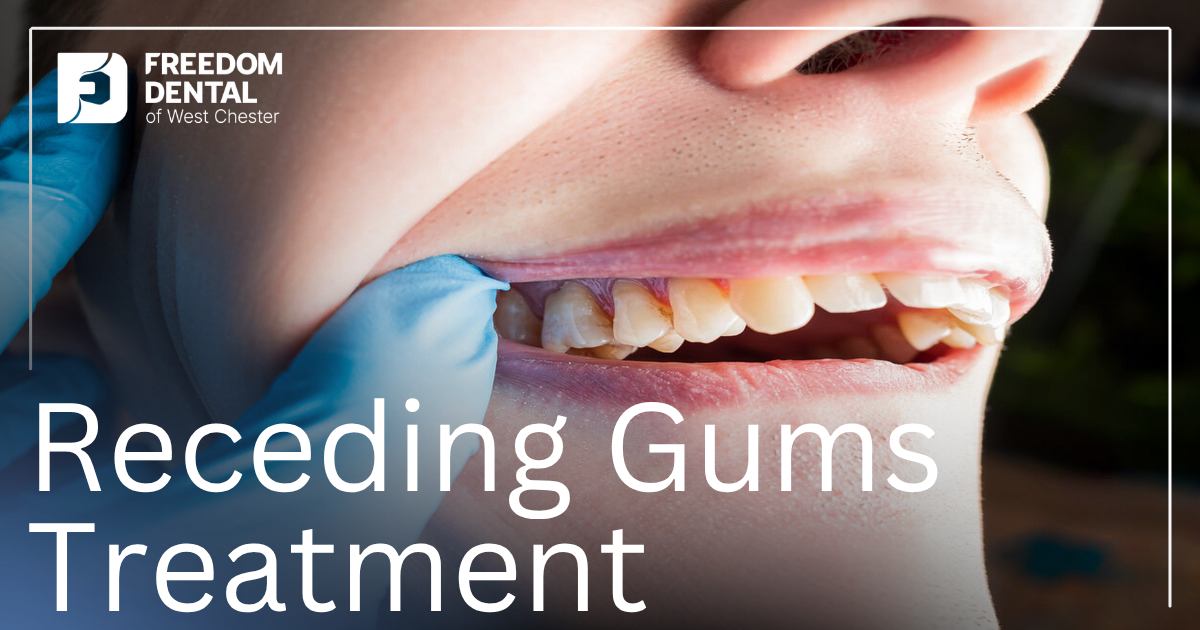 How to Fix Receding Gums