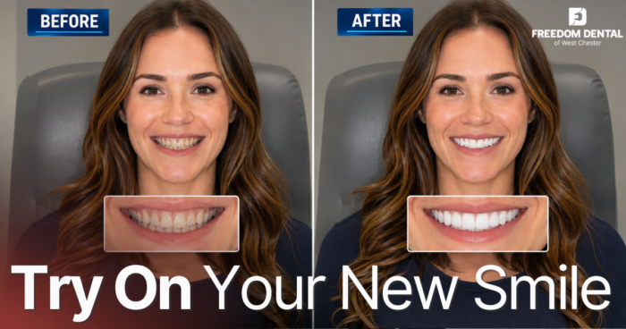 a side. by side before and after of a woman smiling after her new teeth
