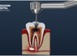 Root Canal Procedure Duration