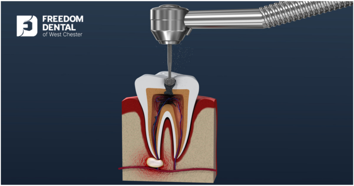 Root Canal Procedure Duration