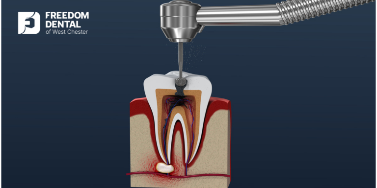 Root Canal Procedure Duration